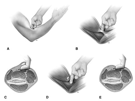 hook test for distal biceps